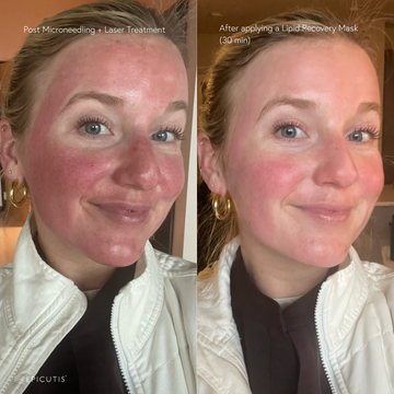 Post-Laser Treatment Skincare