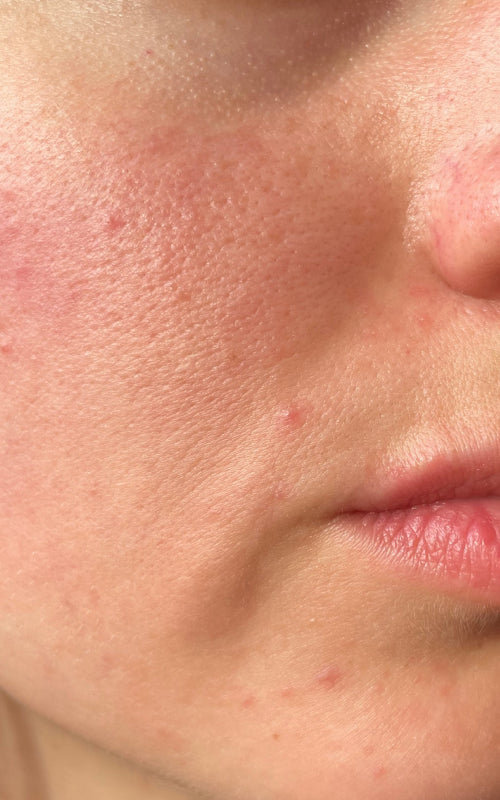 Blemish & Acne Prone