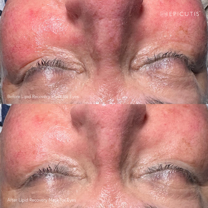 Epicutis Lipid Recovery Mask for Eyes (Pack of 5) Epicutis