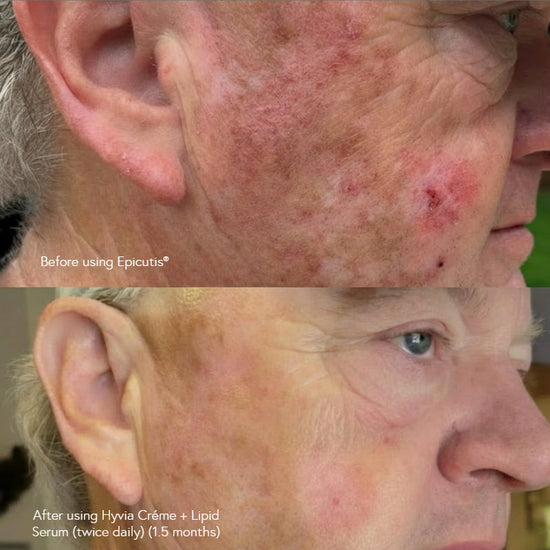 Epicutis Hyvia Crème 50ml Epicutis