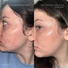 Epicutis Oil Cleanser Before & After