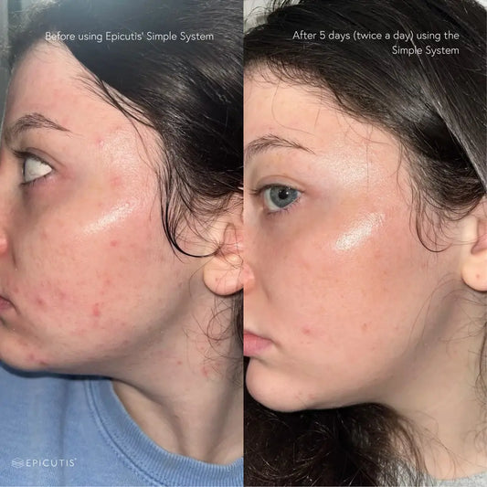 Epicutis Oil Cleanser Before & After