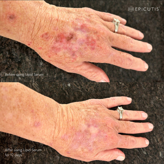 Epicutis Luxury Skincare Set (Lipid Serum 30ml + Hyvia Crème 50ml) Epicutis