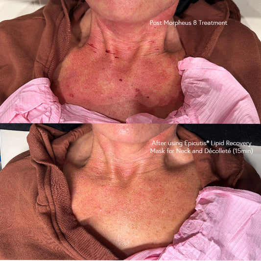 Epicutis Recovery Mask for Neck + Décolleté (pack of 5) Epicutis